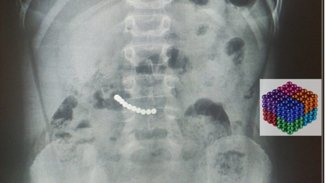 Muğla’da 7 yaşındaki çocuğun midesinden 11 mıknatıs çıktı
